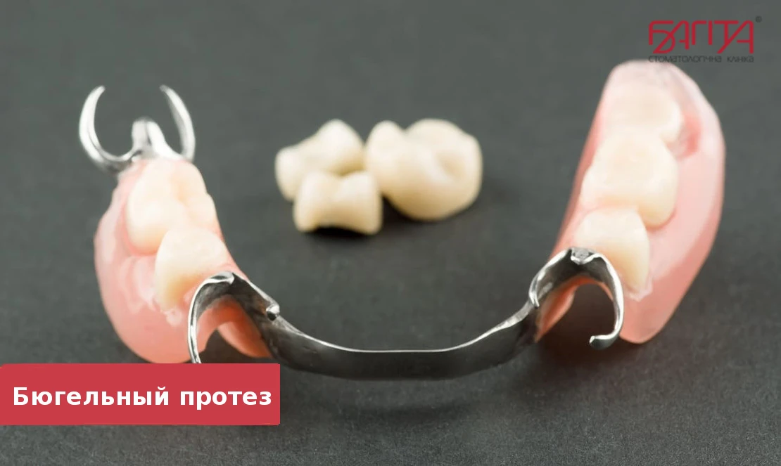 бюгельные протезы для зубов в стоматологии для протезирования в Черкассах