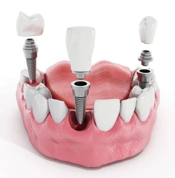на фото хирургический инструмент для стоматологического лечения и удаления зубов