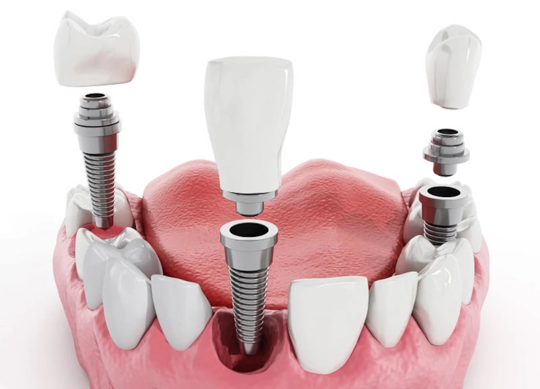 лечение зубов и имплантация в Черкассах и области