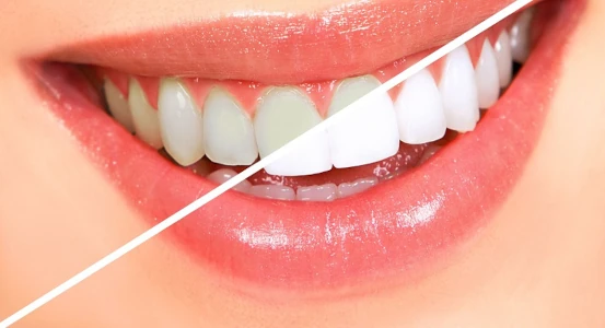 фото зубов до и после отбеливания в стоматологической клинике Багита