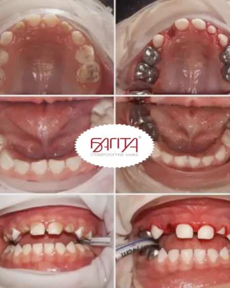 Імплантація зубів на верхній щелепі Cтоматологічна клініка «Багіта»