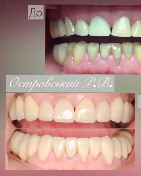 Лікування карієсу Cтоматологічна клініка «Багіта»