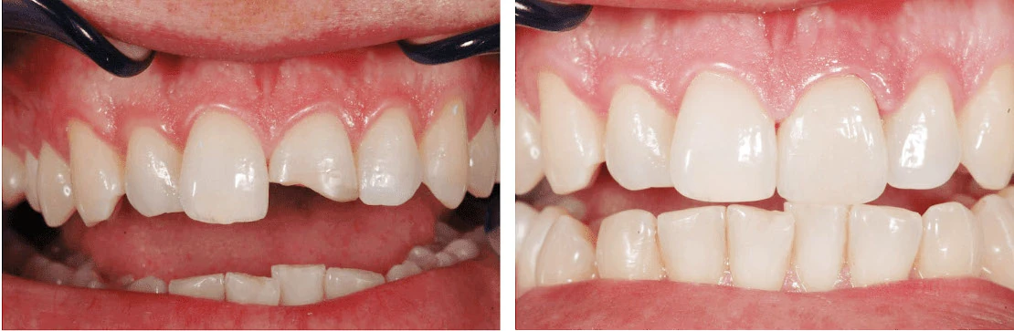 до и после реставрации зубов в стоматологической клинике Багита в Черкассах