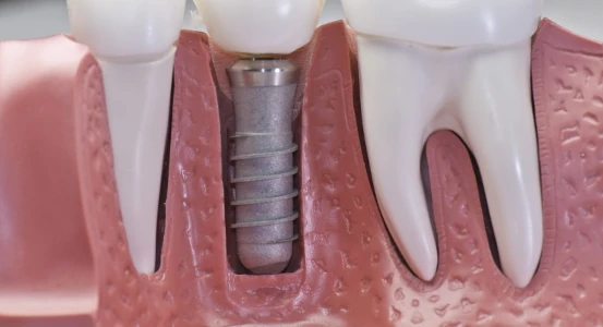 схема импланта в зубном ряду в стоматологической клинике Черкассы