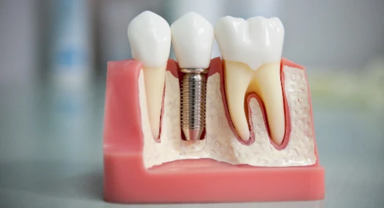 искусственный имплант образец в стоматологии