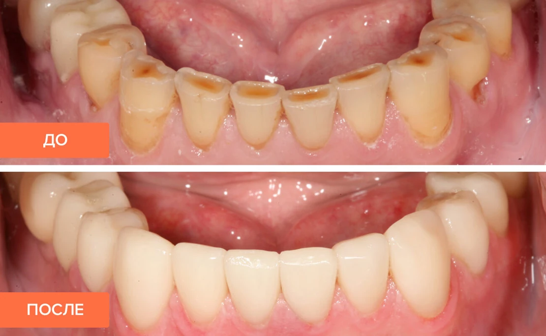 коронки для зубов установленные в стоматологической клинике Багита