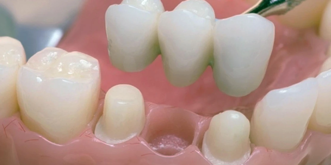 мостовидные протезы для восстановления зубов в стоматологической клинике в Черкассах