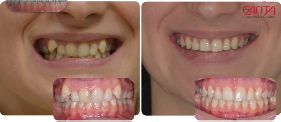 на фото исправление неправильного прикуса до и после лечения у ортодонта в стоматологии Багита