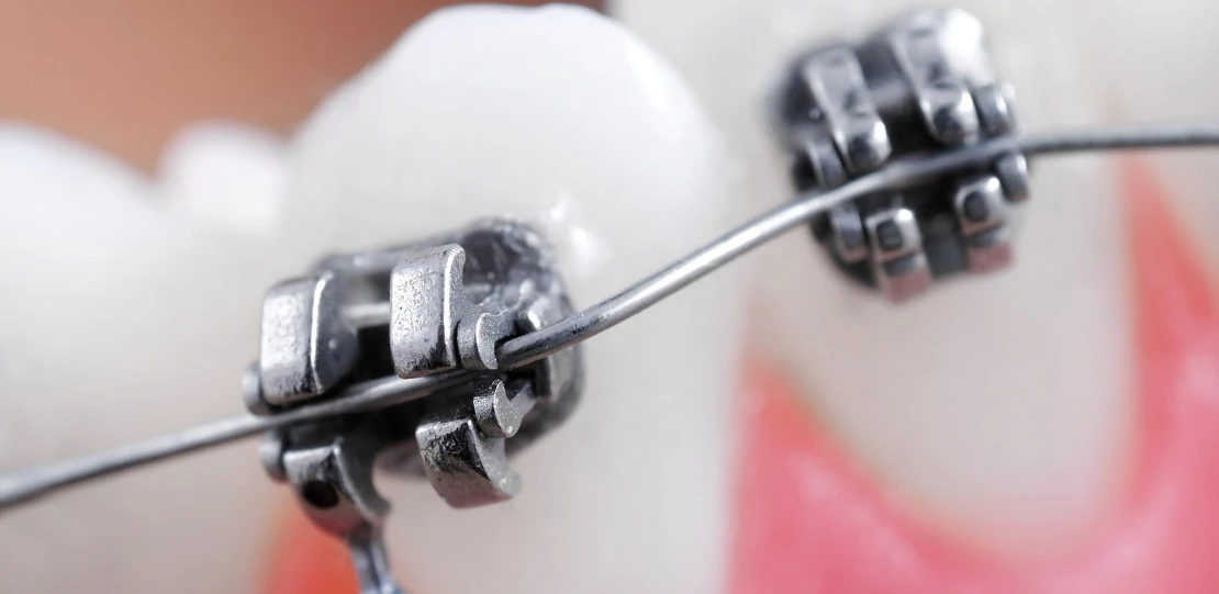 на фото брекеты установленные у ортодонта с ортодонтические дугой для исправления прикуса
