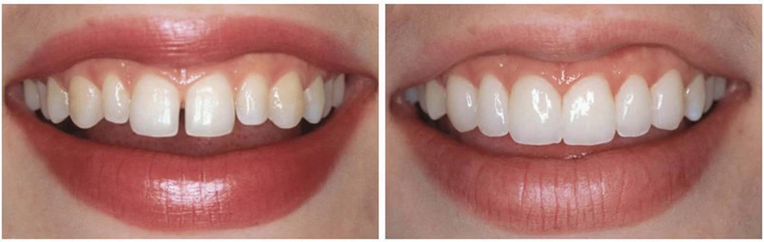 на фото исправление прикуса после лечения у ортодонта в стоматологии Багита