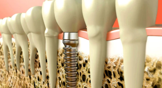 схема импланта в зубном ряду в стоматологии Черкассы