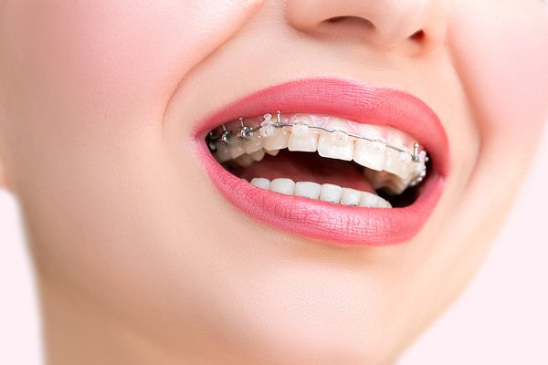 photo of bracket system on teeth at Bagita Dental Clinic