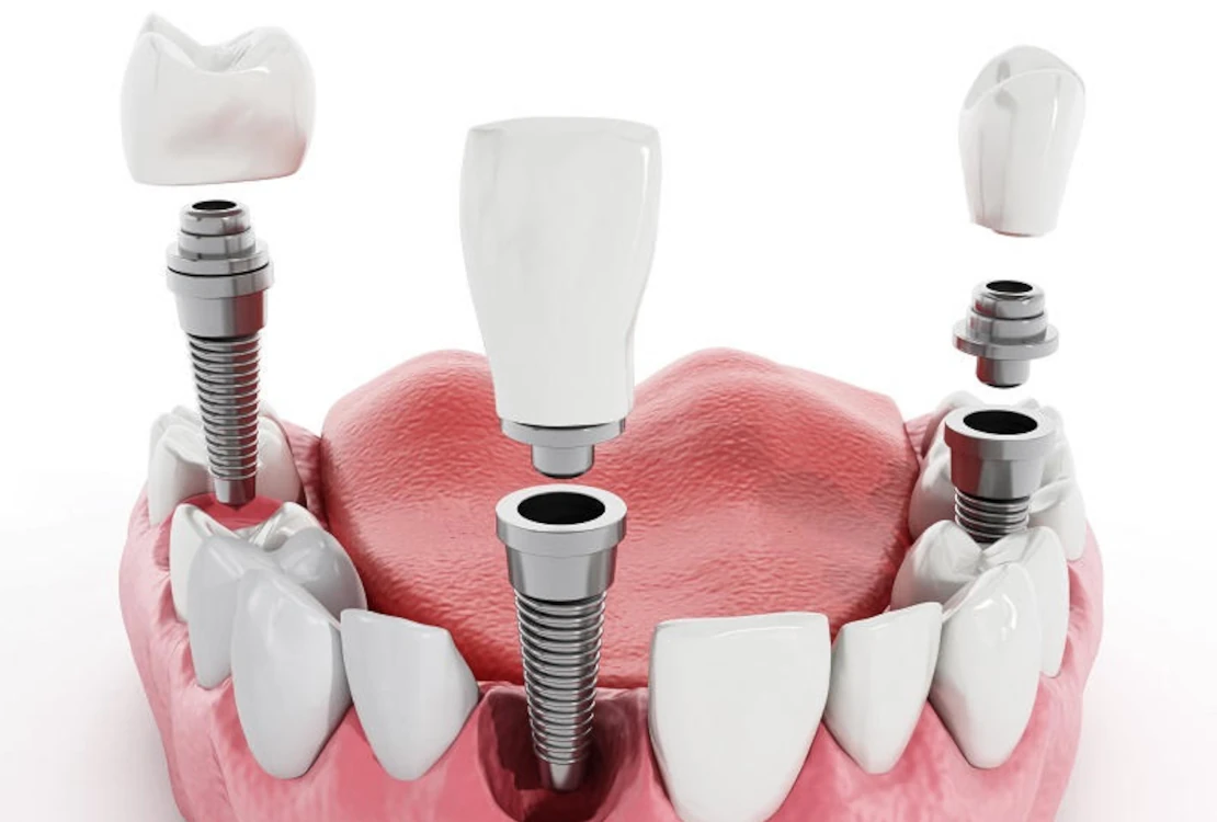scheme of dental implantation in dentistry Cherkassy photo