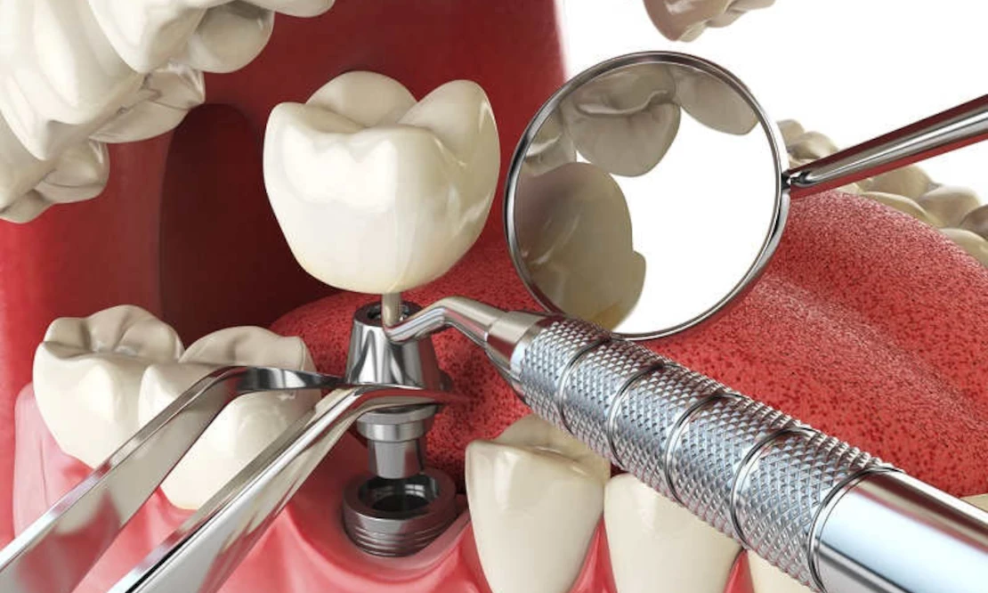 Dental treatment and implantation in Cherkassy and the region