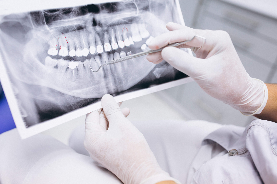 лікування зубів у стоматологічній клініці Багіта в Черкасах