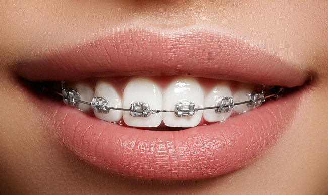 braces problems and wearing difficulties