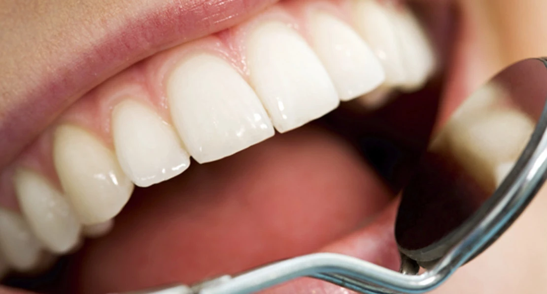 photo of tooth restoration at Bagita Dental Clinic
