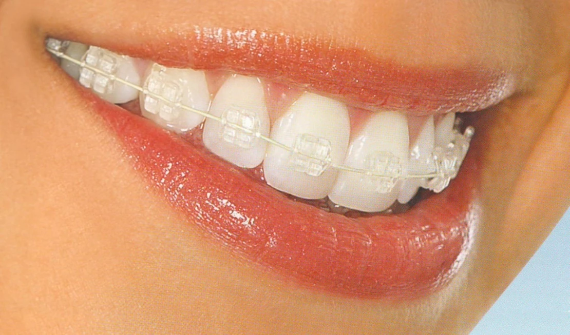 on the photo smile with sapphire braces in aesthetic dentistry in Cherkassy