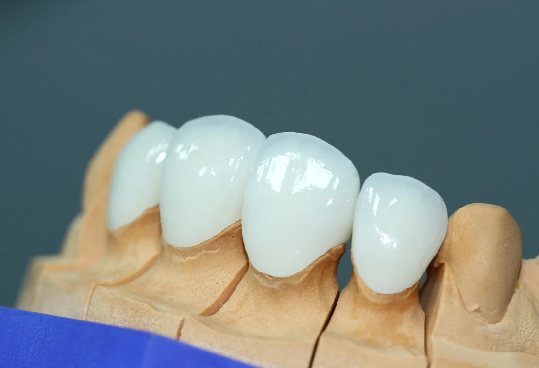 на фото виниры для реставрации зубов в стоматологической клинике Багита