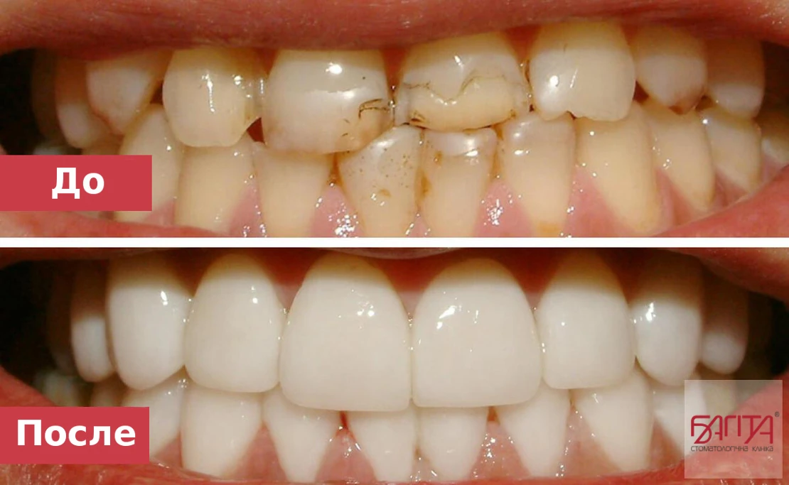 фото до і після встановлення вінірів у Черкасах у стоматологічній клініці Багіта
