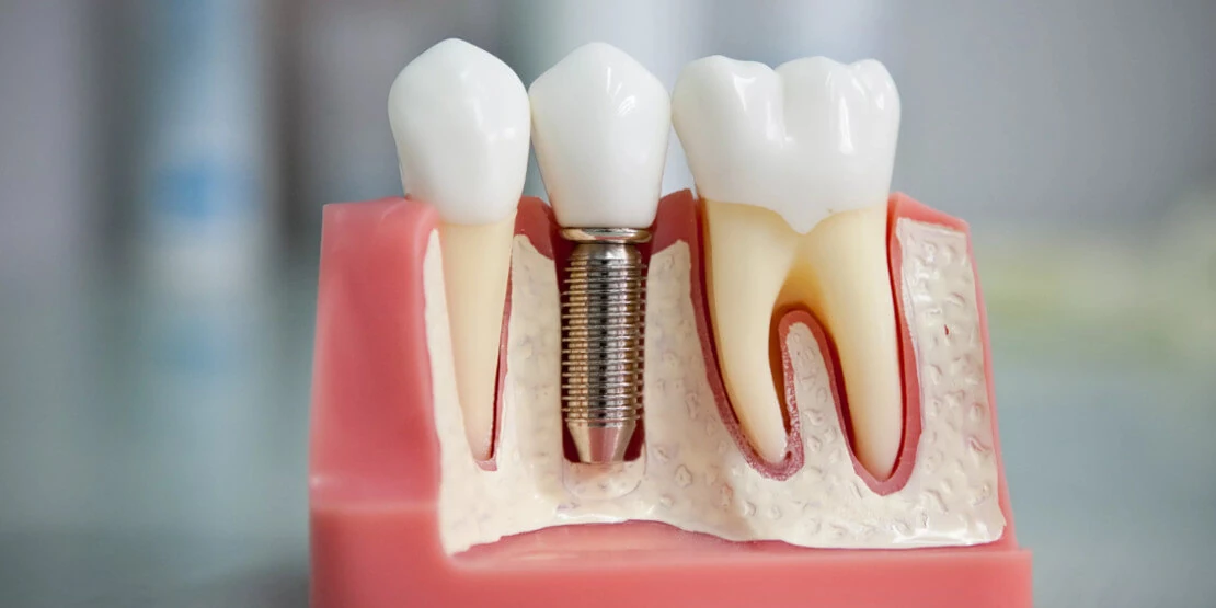 The photo shows a mock-up of an implant inserted into the jaw by a dental surgeon.