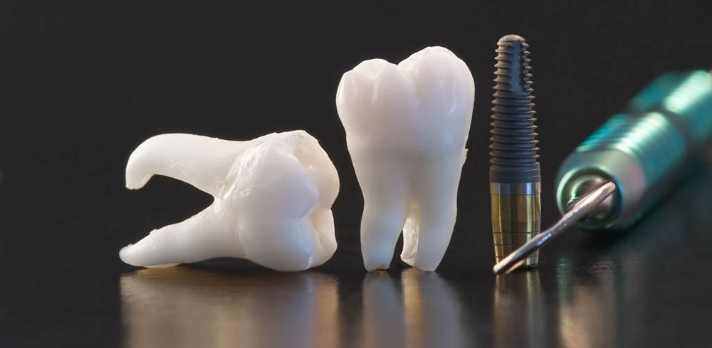 Dental implantation in Cherkassy by Bagita Dental Clinic