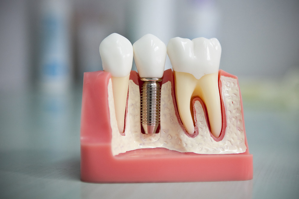 artificial implant sample in dentistry for restoring a tooth row