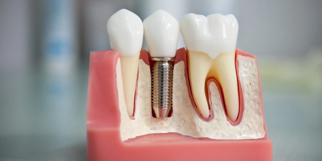types of implants in Bagita dentistry implantation in Cherkassy