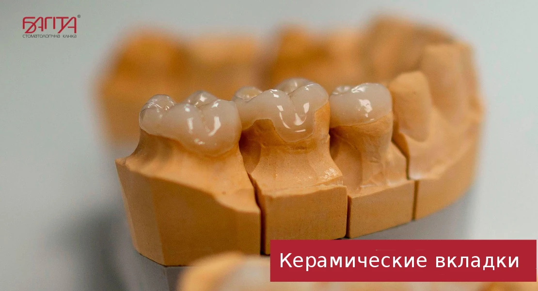 керамічні вкладки для протезування зубів у Черкасах у стоматологічній клініці Багіта в Черкасах