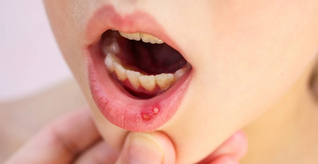 на фото стоматит у дитини в порожнині рота, на нижній губі