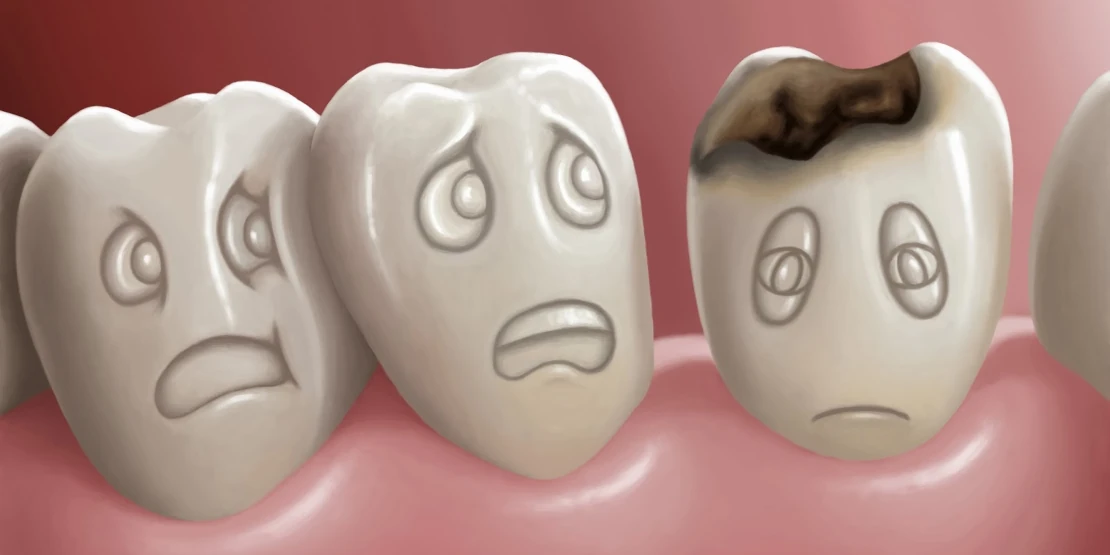 why do cavities appear?