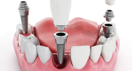 scheme of dental implantation in dentistry Cherkassy photo
