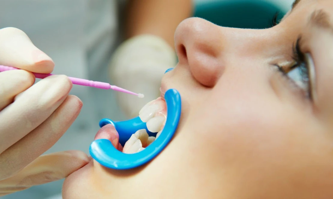 Dental fluoridation at Bagita Dental Clinic