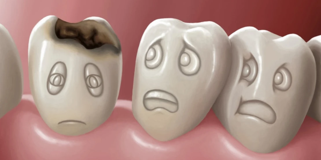 why tooth decay occurs