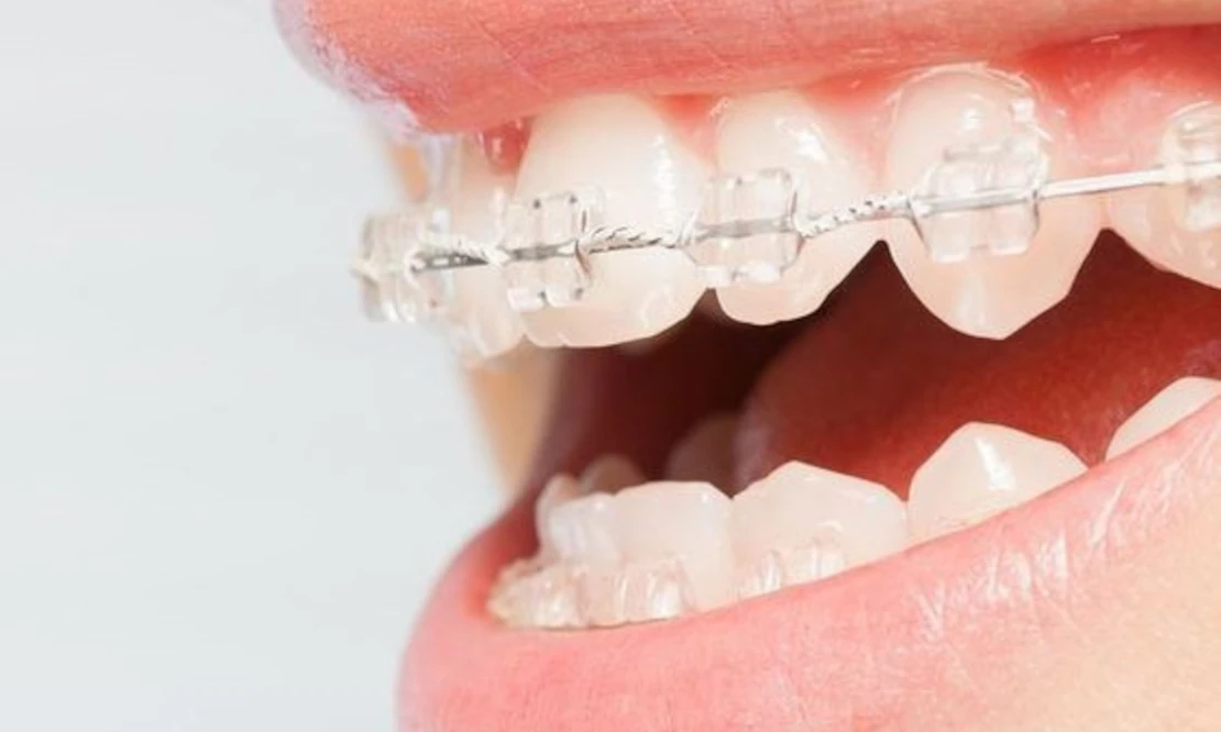 bracket system installed to correct the bite by an orthodontist
