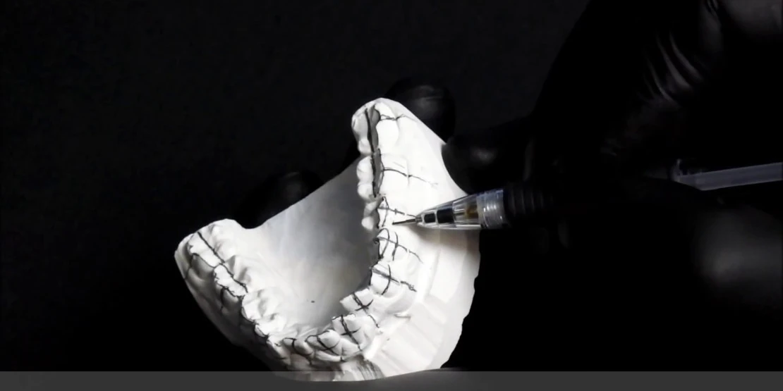installation of braces indirectly by an orthodontist using a plaster model of the jaw