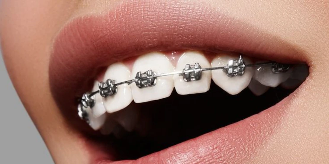 on the photo a bracket system installed at the orthodontist to correct the bite