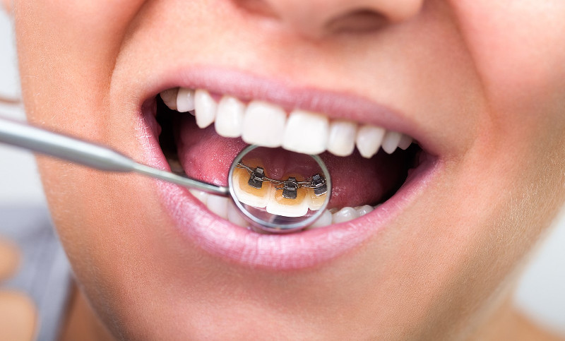 Ортодонтическая пластина на зубах в стоматологической клинике Черкассы фото