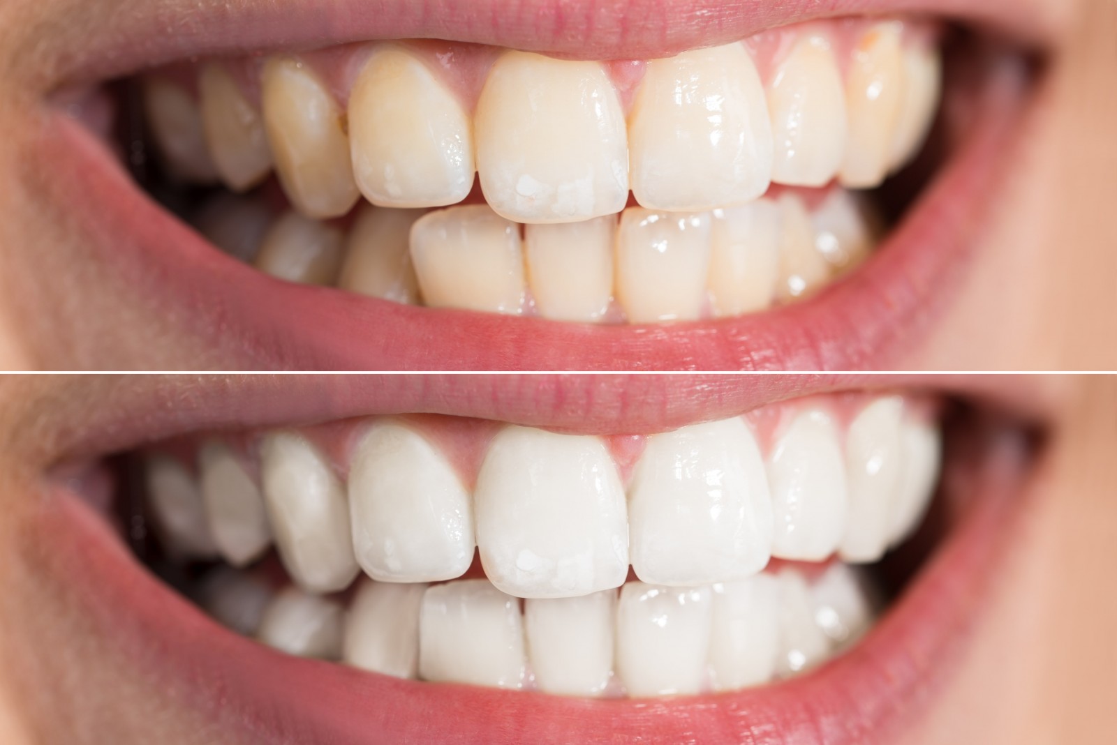 dental fillings and teeth whitening at Bagita Clinic
