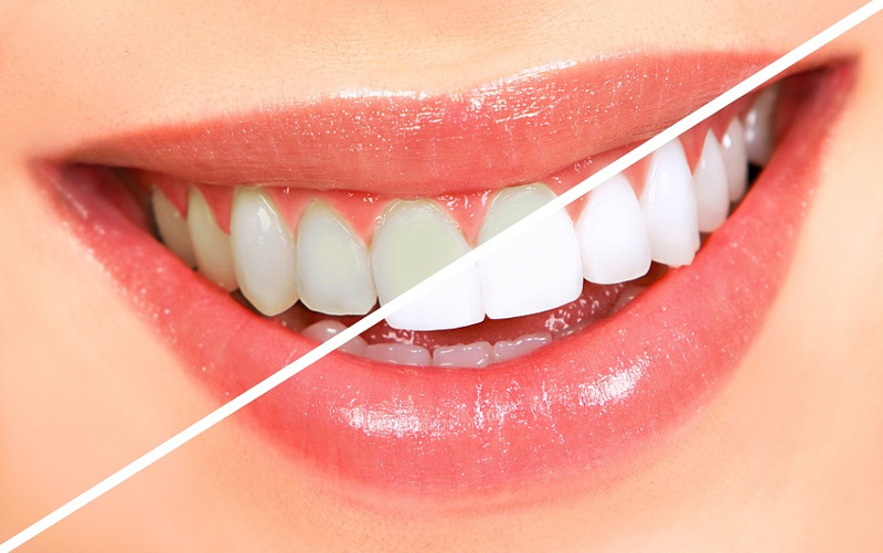 photo of teeth before and after whitening at Bagita Dental Clinic