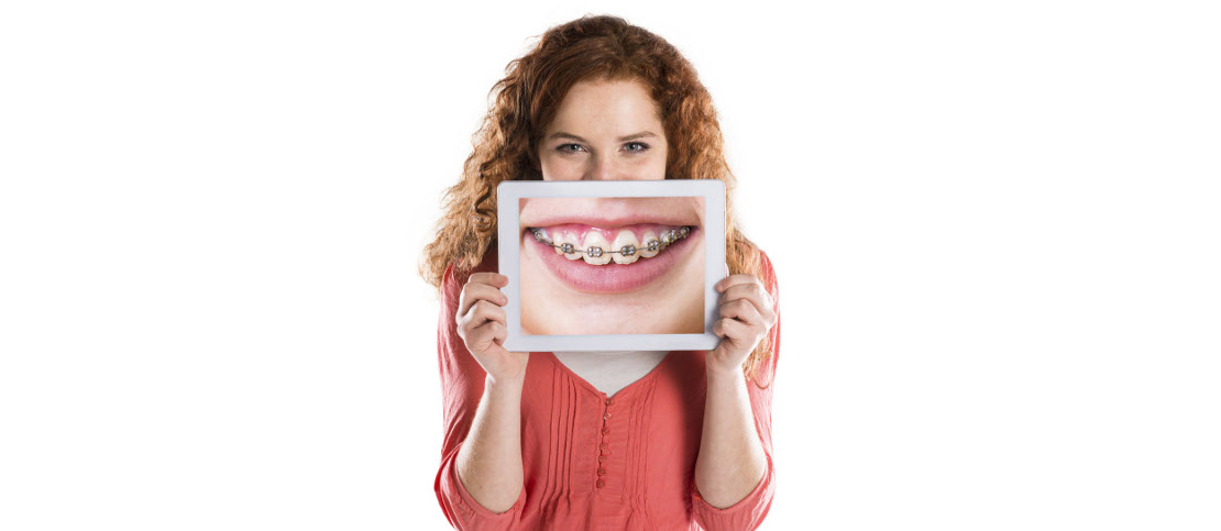 девушка с фото брекетов на зубах