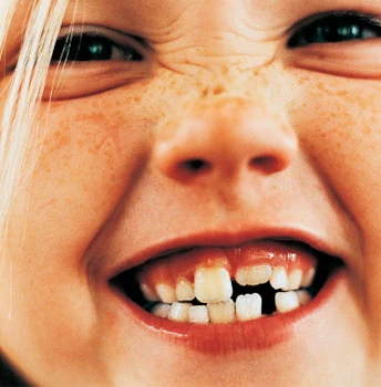 photo of a child with baby teeth after dental treatment at the dentist
