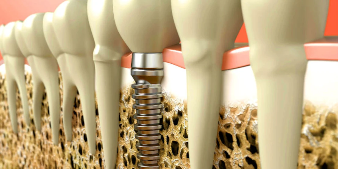 implant scheme in dentistry Cherkassy
