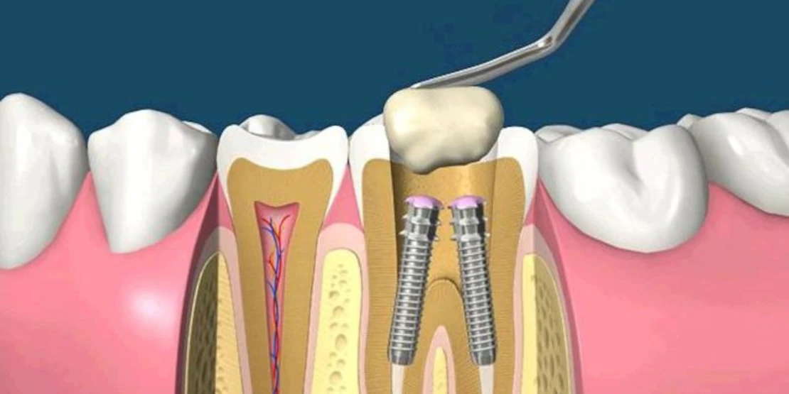 implant in dentistry Cherkassy