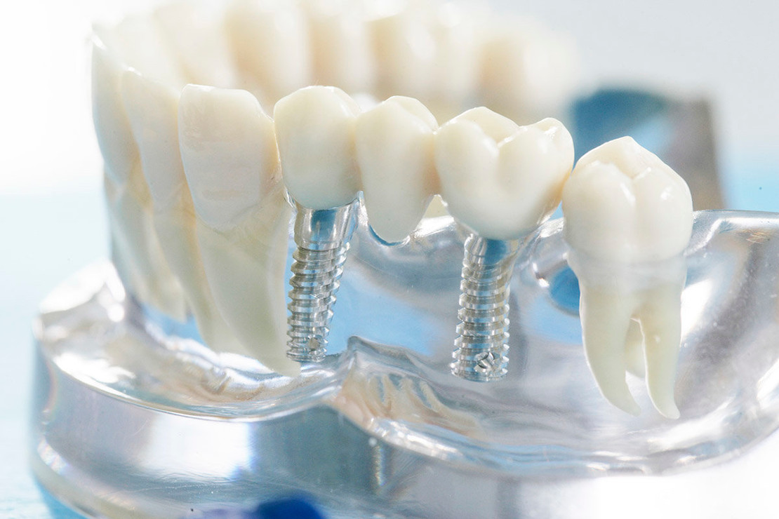 на фото макет протезов импланта для восстановления зуба в стоматологии Черкассы