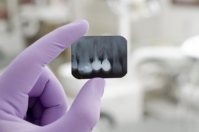 снимок рентгена зубов в стоматологии Черкассы