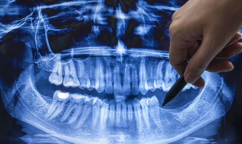 Что будет, если удалить зуб и не поставить коронку или имплант