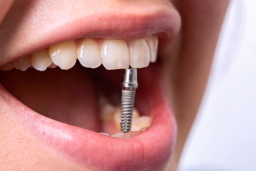 photo of a tooth implant in the dental Cherkassy clinic