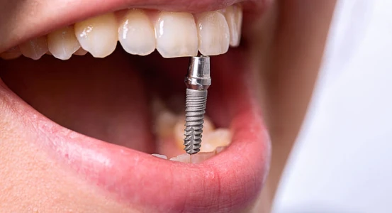 photo of a tooth implant in a dental clinic in Cherkassy