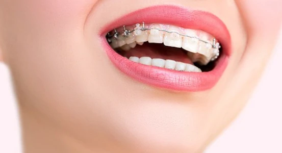 photo of bracket system on teeth at Bagita Dental Clinic